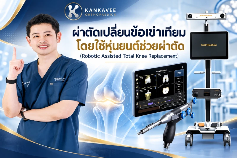 ผ่าตัดเปลี่ยนข้อเข่าเทียมโดยใช้หุ่นยนต์ช่วยผ่าตัด (Robotic Assisted Total Knee Replacement)